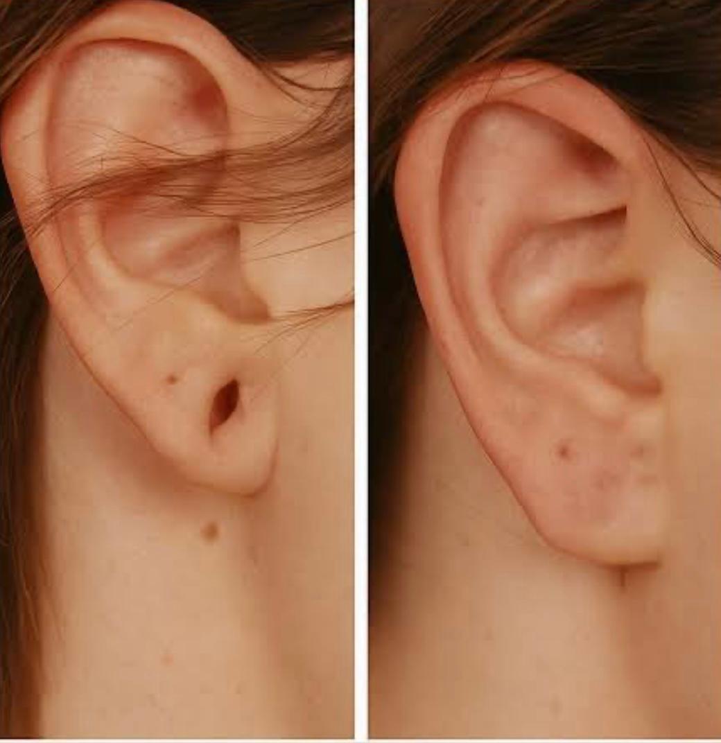 Lobuloplastia